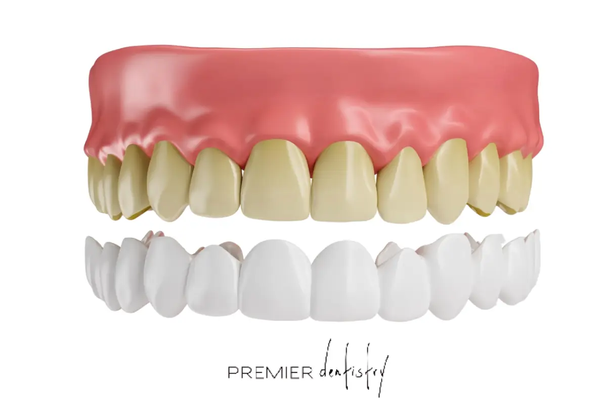 3d model teeth with veneers 