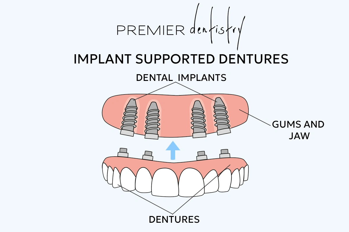 Illustration of Implant Supported Dentures