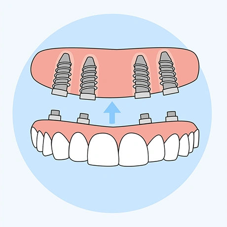 Illustration of Full Arch Restoration