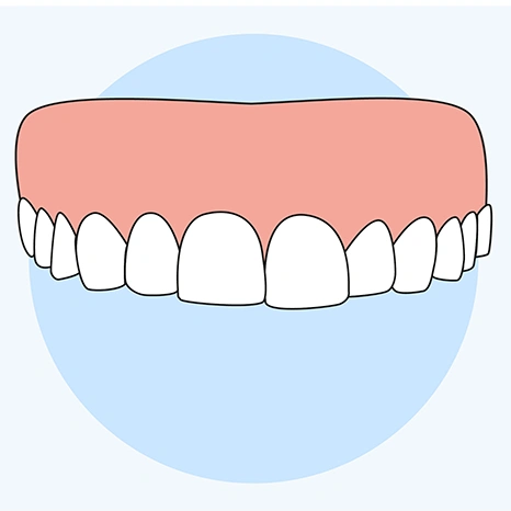 Illustration of Implant Supported Dentures