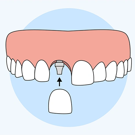 Illustration of single tooth implants