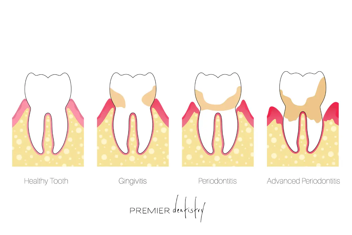 gingivities 4 stages illustration