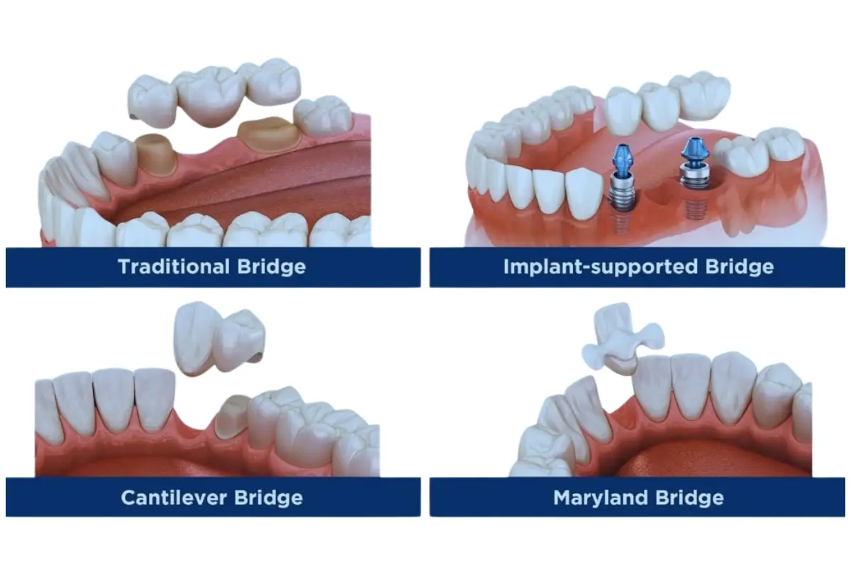 illustration of different types of dental bridges